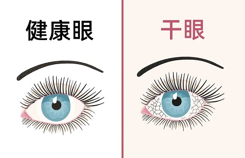 如何预防干眼？